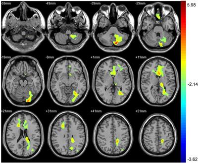 The Impact of Carotid Artery Stenting on Cerebral Perfusion, Functional Connectivity, and Cognition in Severe Asymptomatic Carotid Stenosis Patients